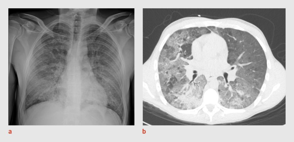 Figuur 1 | Thoraxfoto en CT-thorax van patiënt A