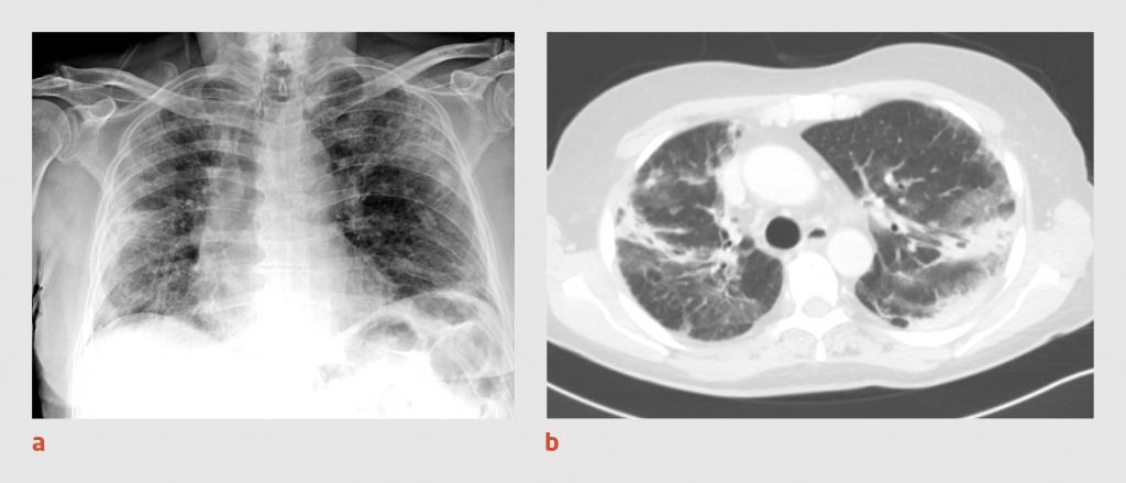 Figuur 2 | Thoraxfoto en CT-thorax van patiënt B