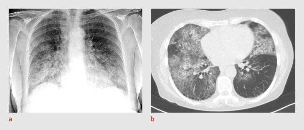 Figuur 3 | Thoraxfoto en CT-thorax van patiënt C