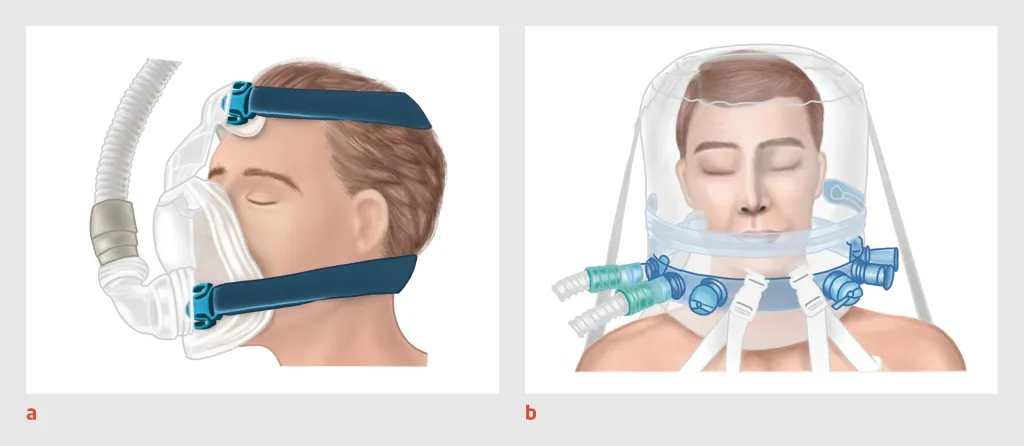 Figuur 3 | Continue positievedrukbeademing (CPAP) en niet-invasieve beademing (NIV)