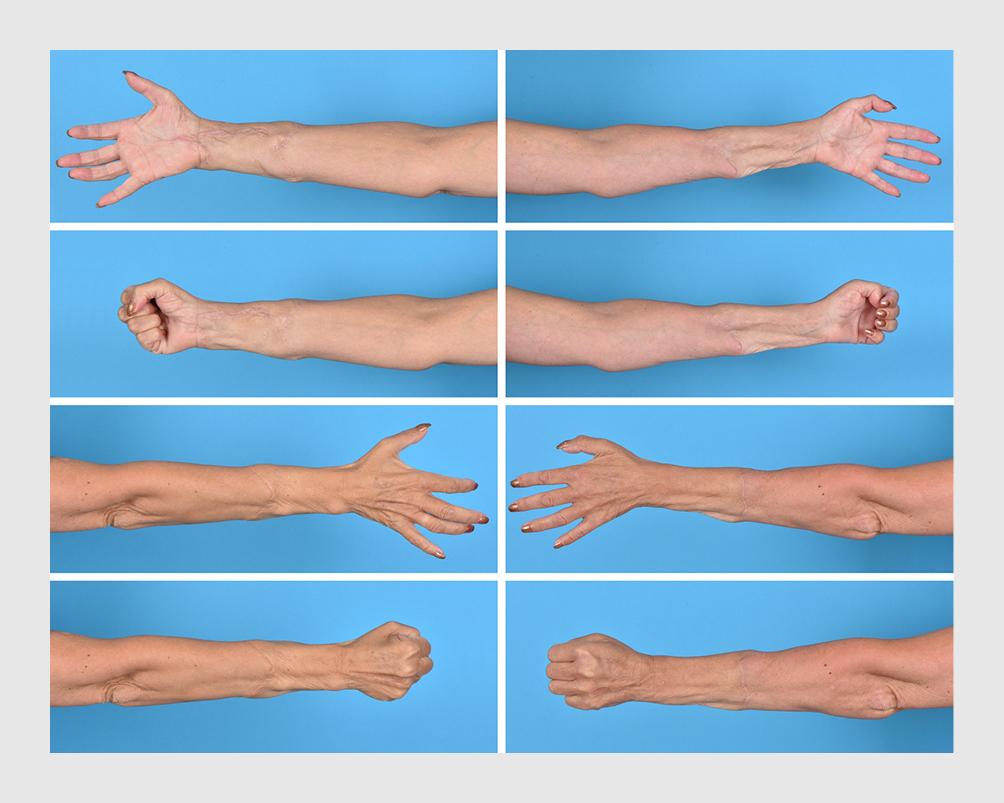 Figuur | Beweeglijkheid van de handen na dubbelzijdige handtransplantatie | De patiënte is zeer tevreden met haar handen