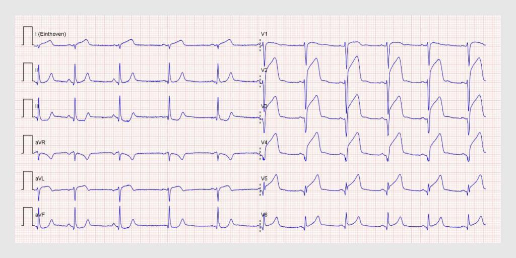 Figuur 1 | Ecg van patiënt A