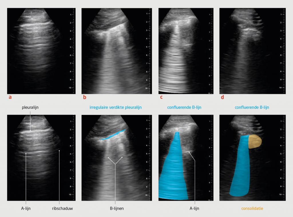 Figuur | Echobeelden van de long zonder en met afwijkingen die kunnen passen bij covid-19-pneumonie