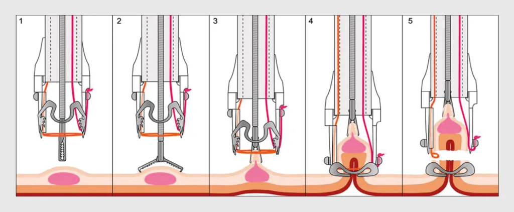 Figuur 1 | Schematische weergave van endoscopische ‘full-thickness’-resectie