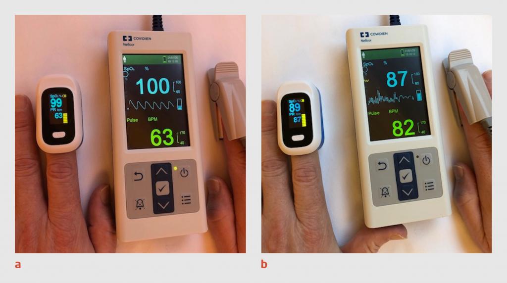 Figuur 3 | Uitslag van verschillende pulsoximeters bij een patiënt zonder en met tremor