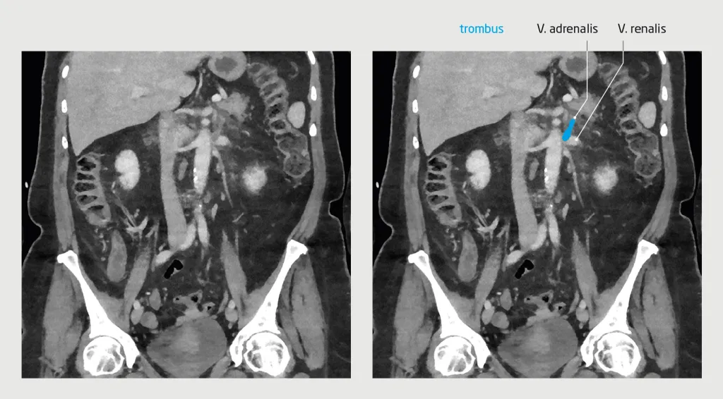 Figuur 1 | Trombose van de V. renalis en V. adrenalis