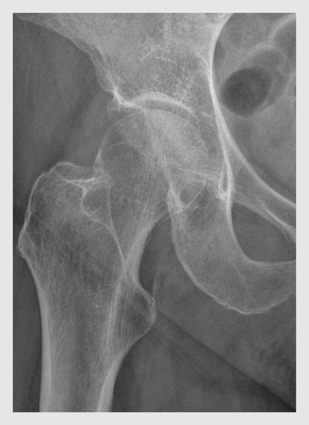 Figuur 1 | Röntgenfoto van de heup van patiënt A