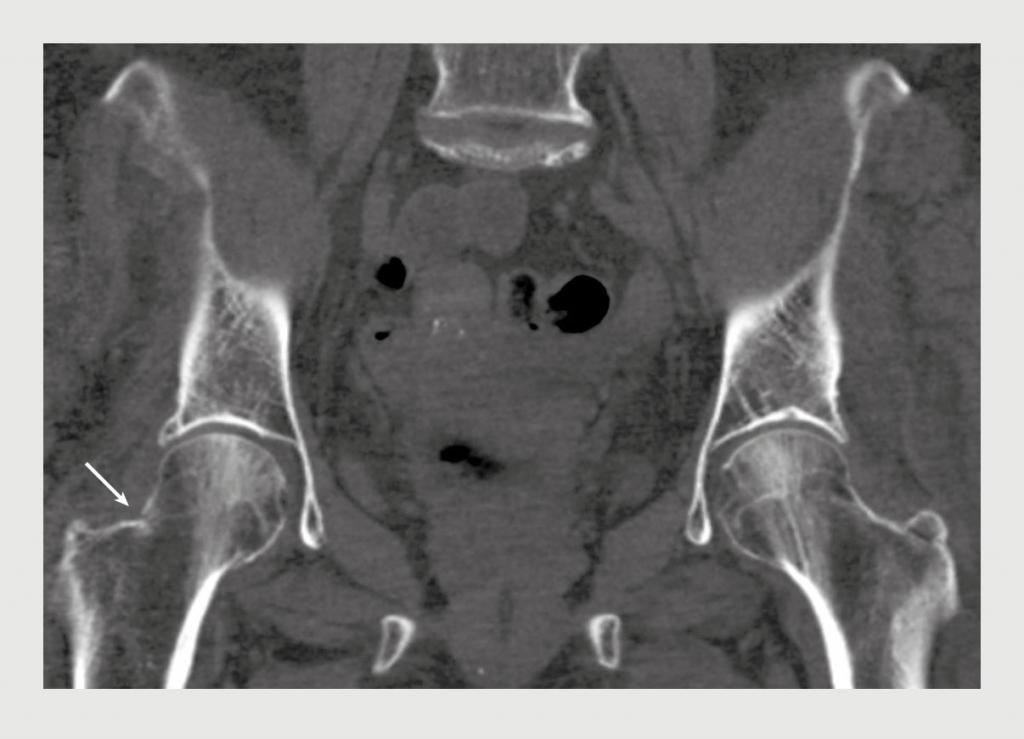 Figuur 2 | CT-scan van het bekken van patiënt A