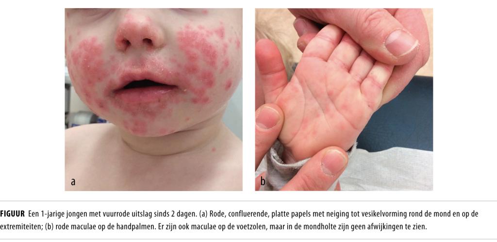 Een kind met koorts en uitslag | NTvG