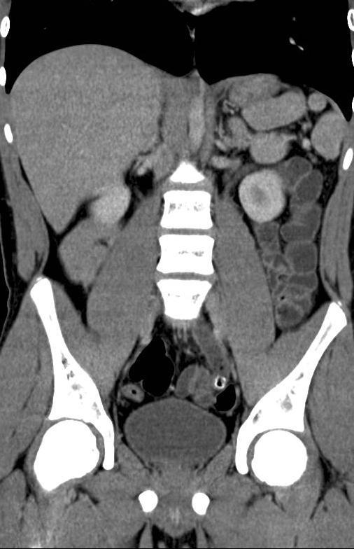 Een jongen met pijn links onder in de buik NTVG