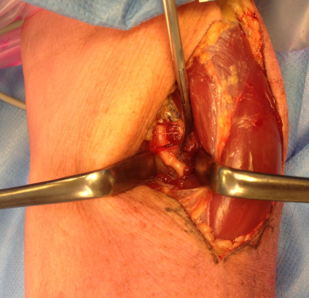 operatiefoto van de arm