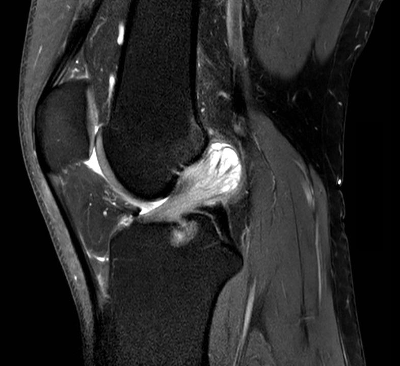 MRI van de linker knie