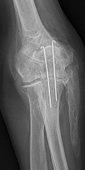 Röntgenfoto van de elleboog