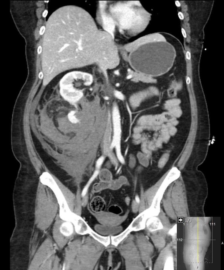 acuut ontstane flankpijn