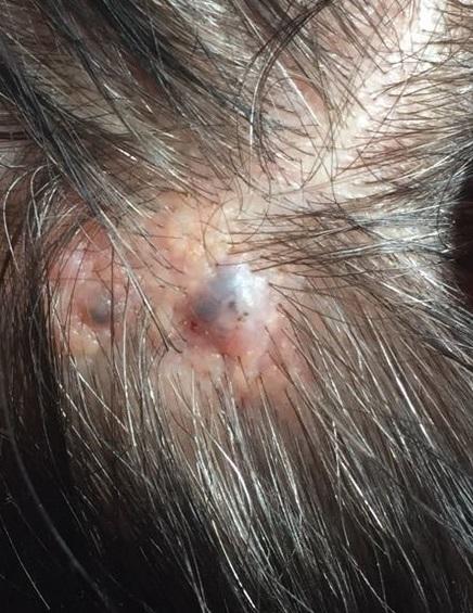 gele plek op hoofdhuid