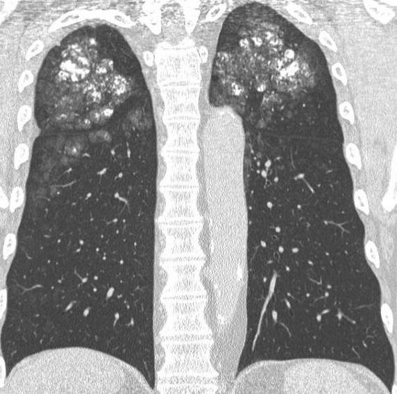 scan van de longen