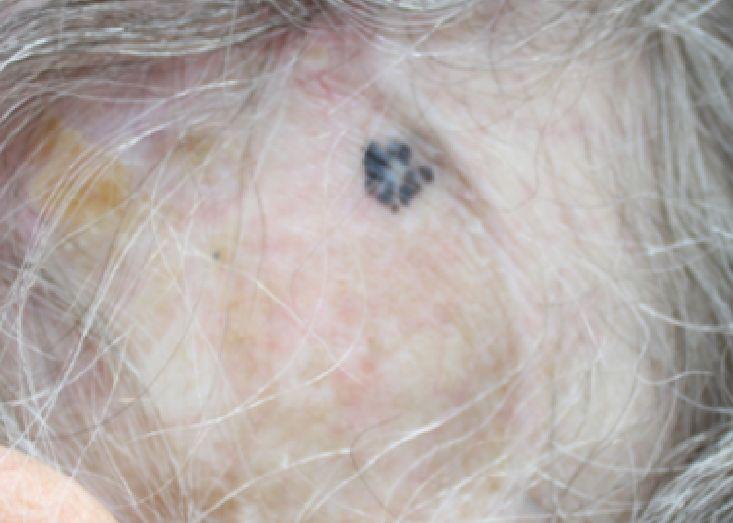 litteken melanoom
