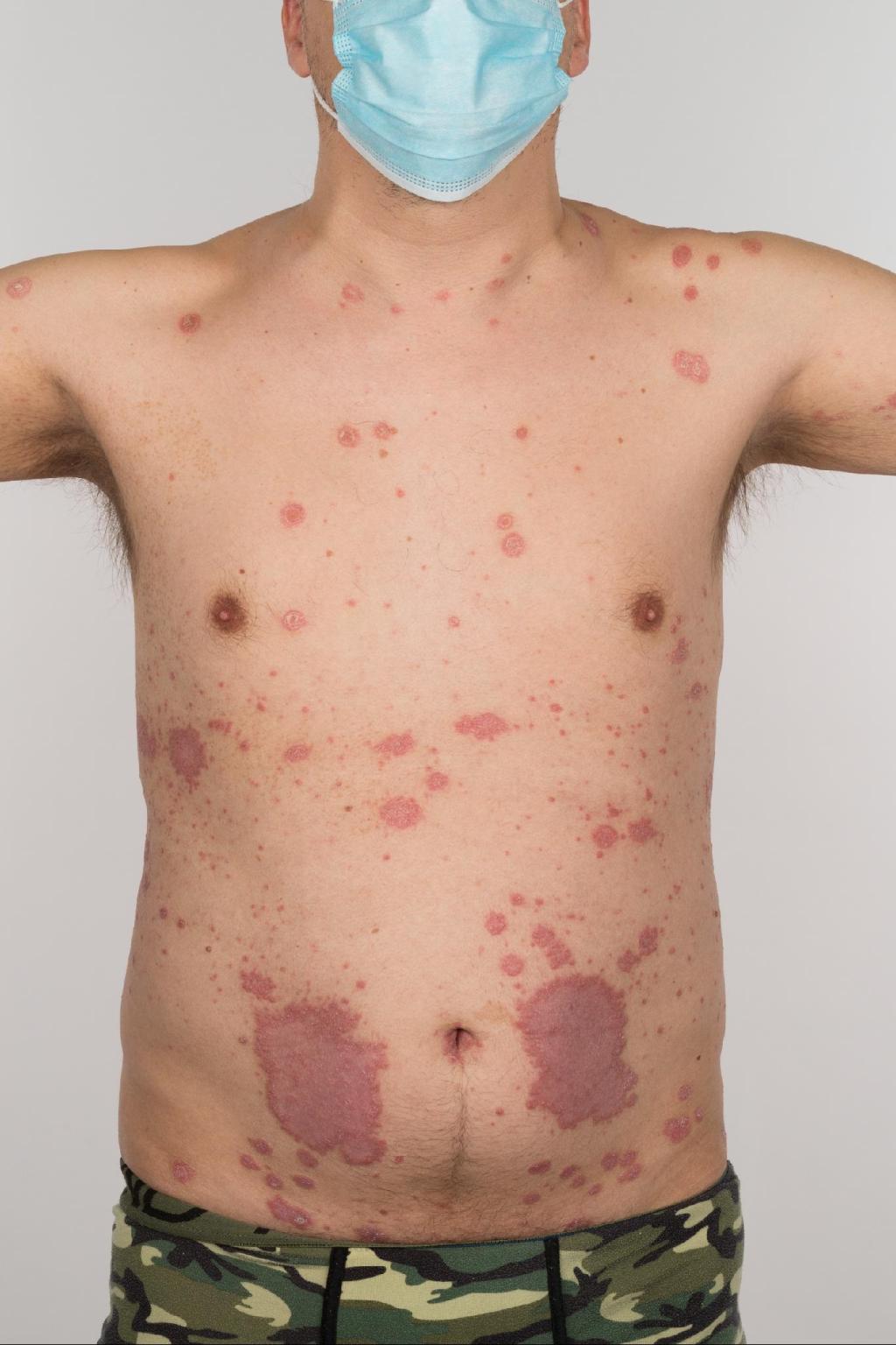 Rode, schilferende plekken verspreid over het lichaam.