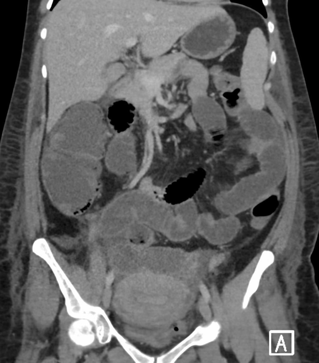 Een CT-scan van het abdomen.