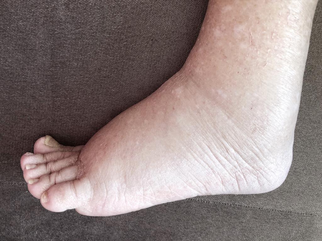 Een voet met oedeem.