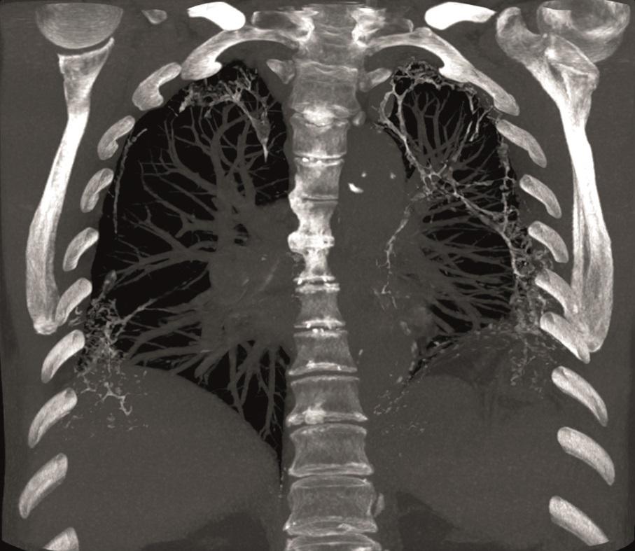 CT-scan van de thorax.