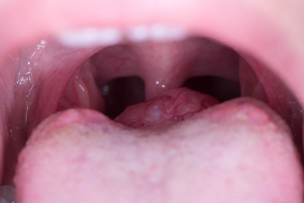 Een zwelling achter op de tong.