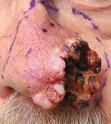 Een tumor op de neus.