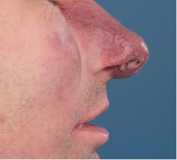 Foto ‘en profile’ van de neus van een 42-jarige man met sinds 8 maanden een pijnloze, progressieve huidafwijking op zijn neus.