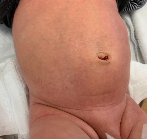 Romp van een pasgeborene met vaattekening op de buik.