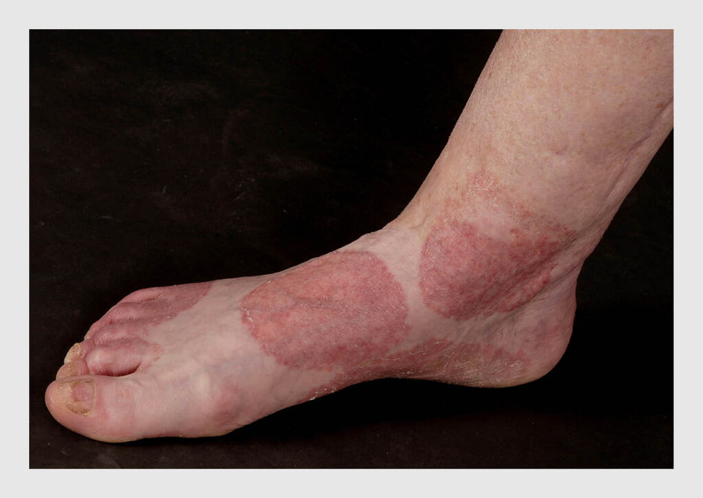 Figuur 1 | Schimmelinfectie van de voet