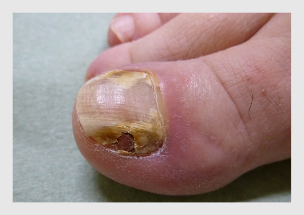 Figuur 2 | Onychomycose
