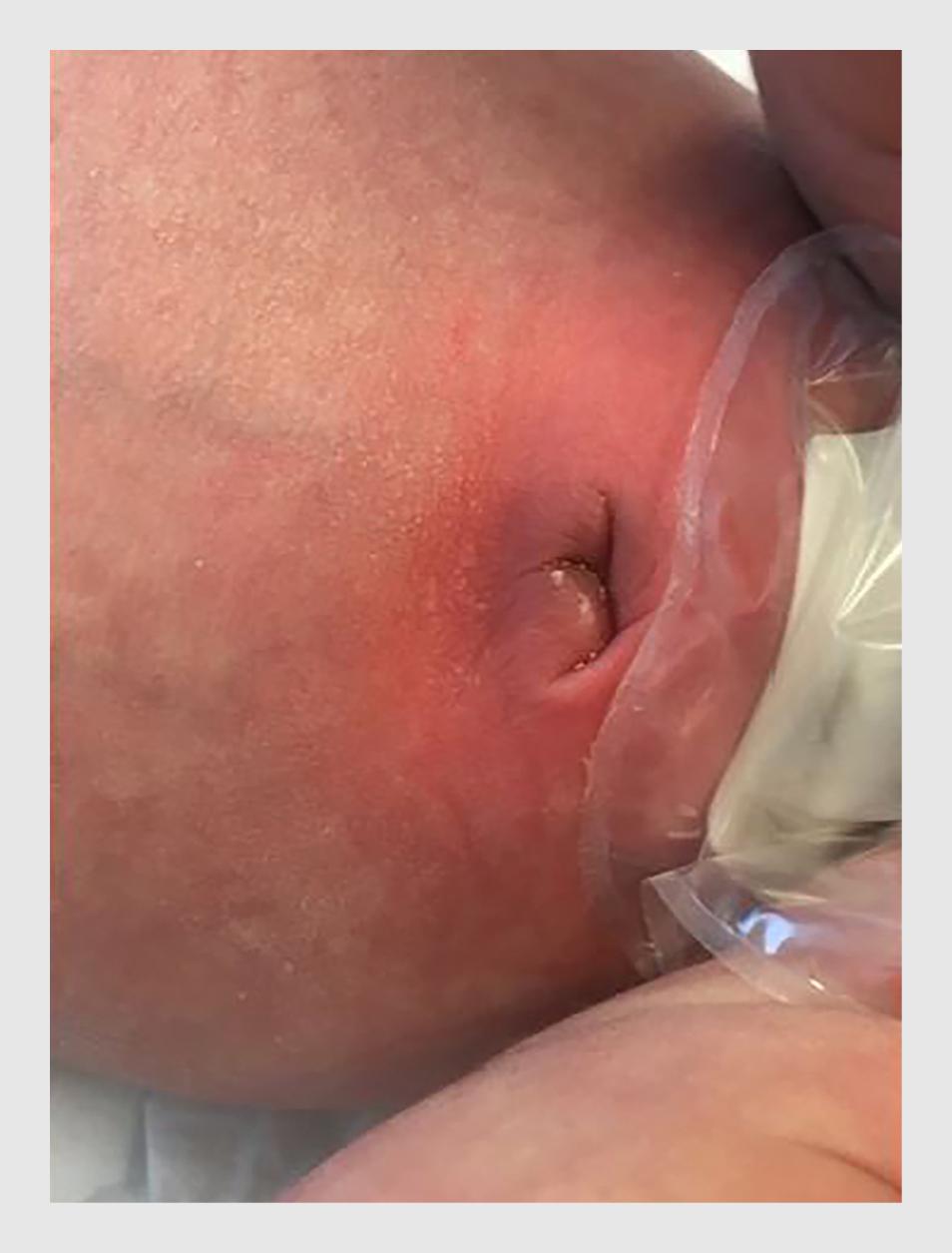 Figuur 1 | Omfalitis