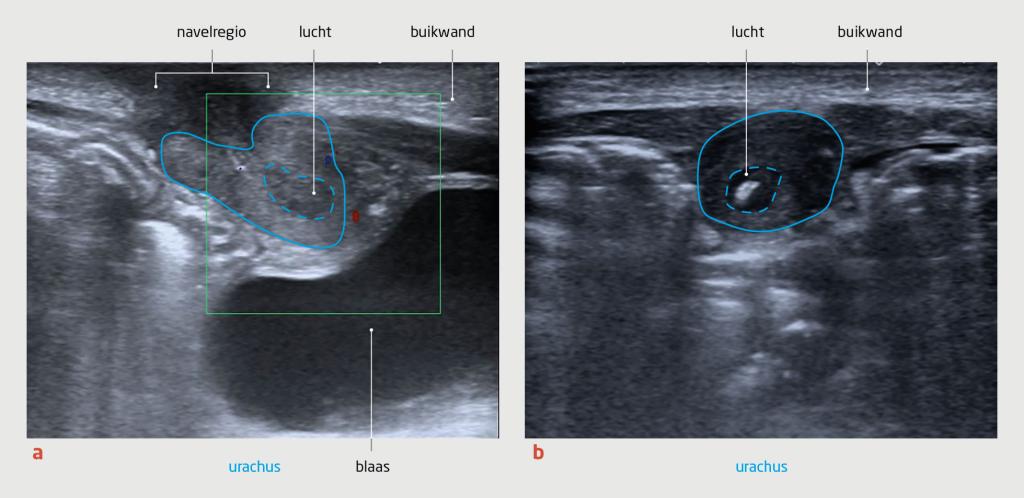 Figuur 2 | Ontstoken urachusweefsel