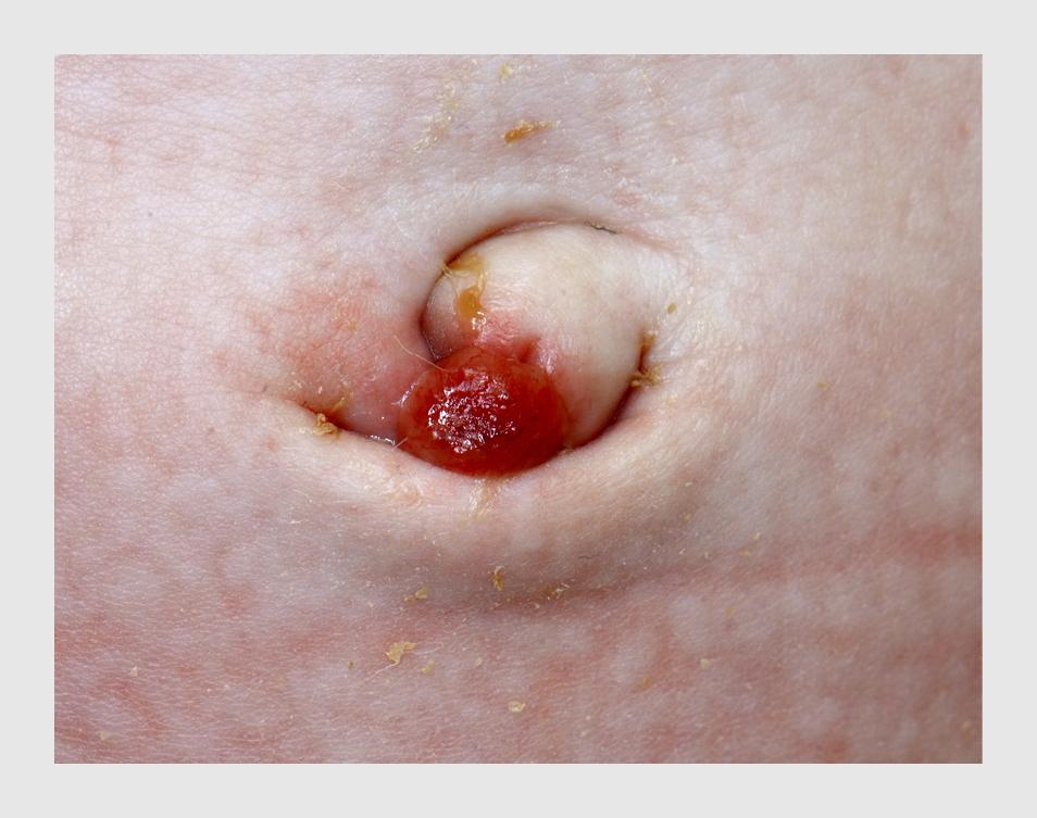 Figuur 3 | Navelgranuloom