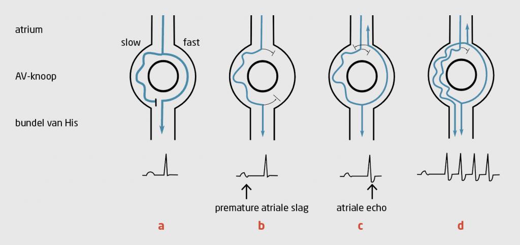 Figuur 4 | Het mechanisme van atrioventriculaire nodale ‘re-entry’-tachycardie