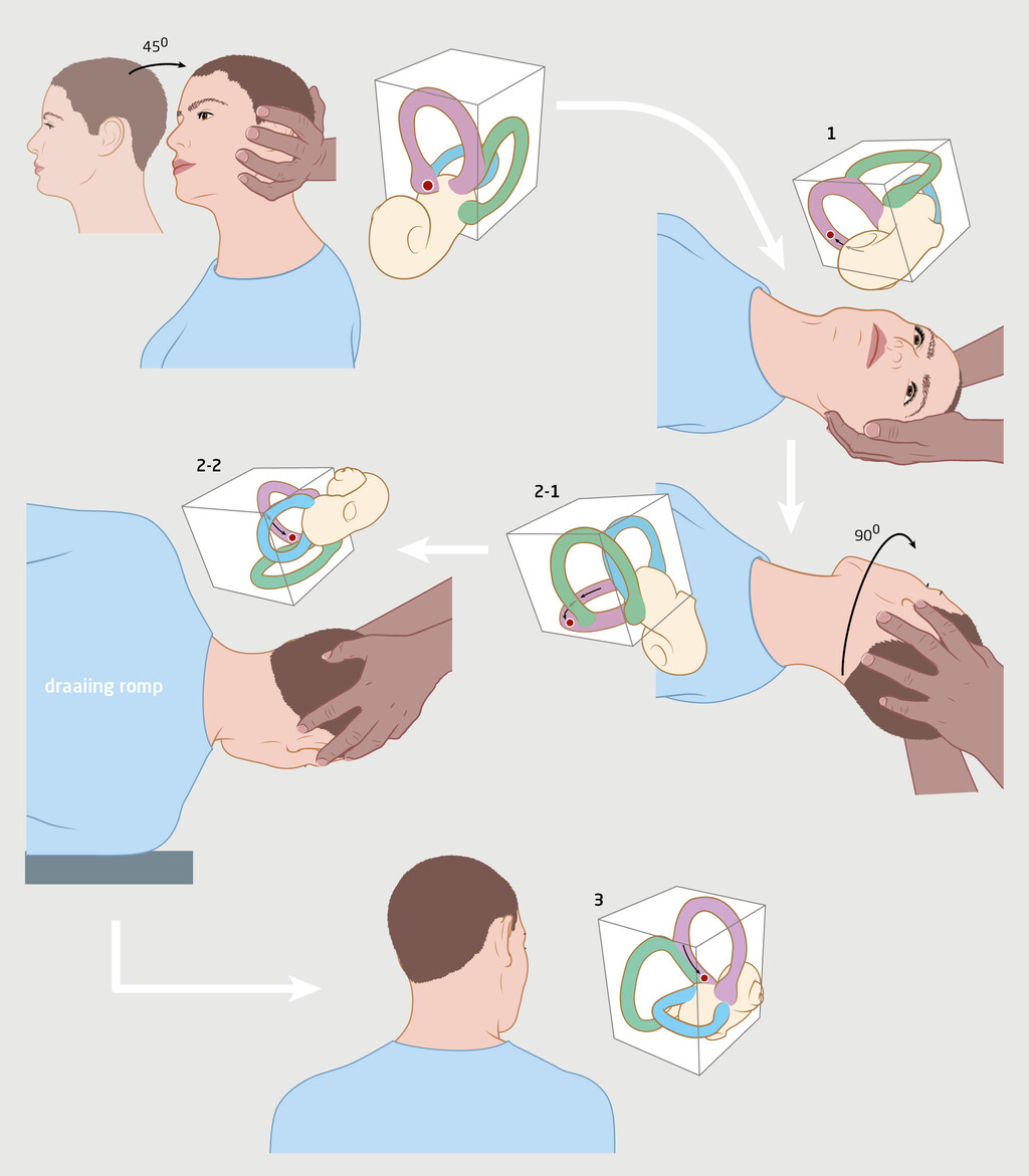 Figuur 2 | Therapeutische kantelmanoeuvre volgens Epley