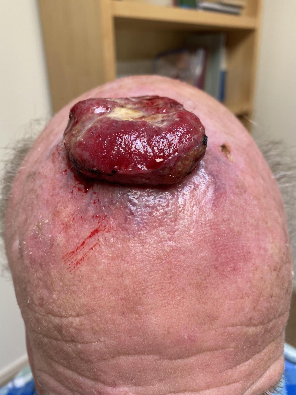 Een bloedende tumor op het hoofd.