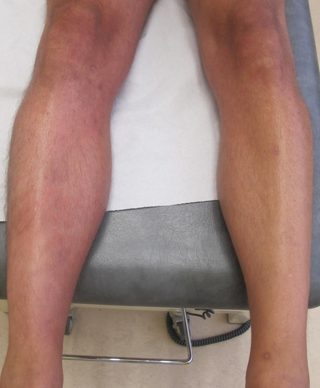 Rode benen op een doktersbed.