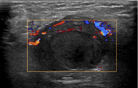 Doppler-echo van een lies.