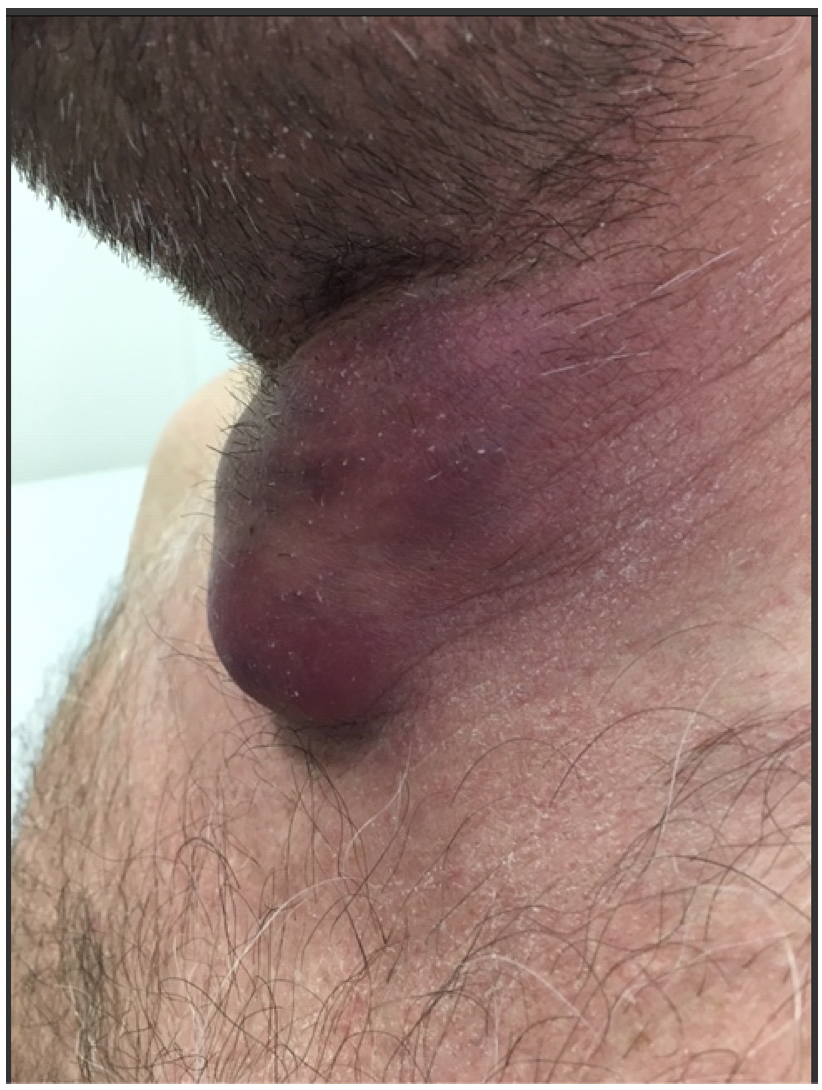 Een roodpaarse zwelling op een hals van een man met een diameter van ongeveer 4 cm..