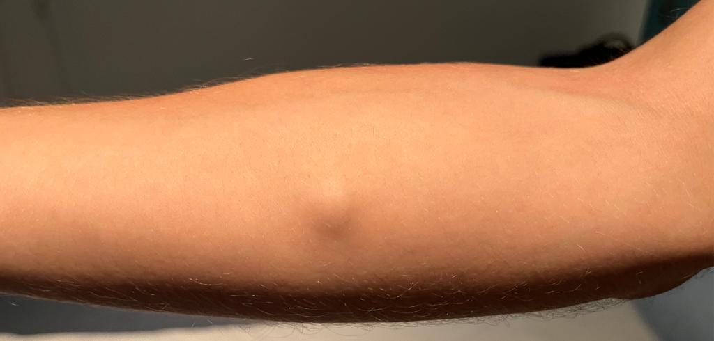 arm met gek bobbeltje.