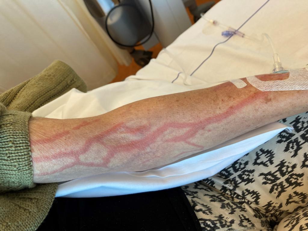 Een onderarm met allemaal huiduitslag in het verloop van de venen.