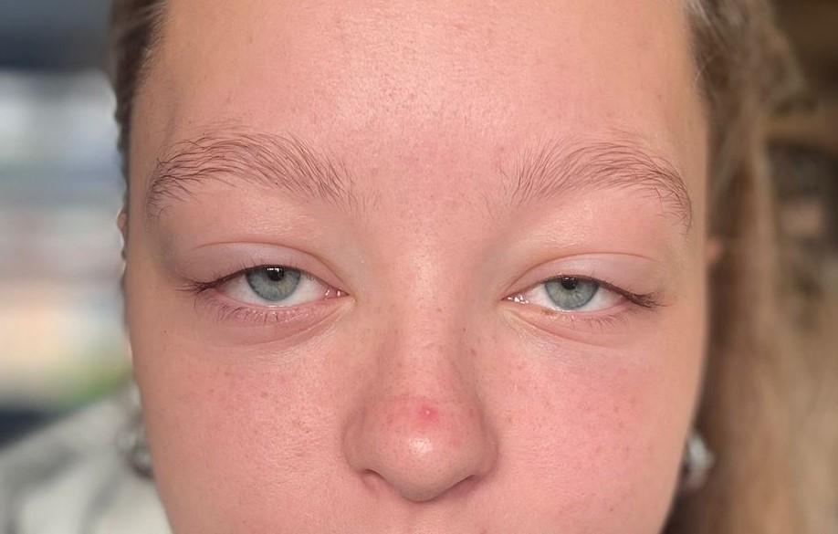 Een meisje met oedeem van de bovenoogleden
