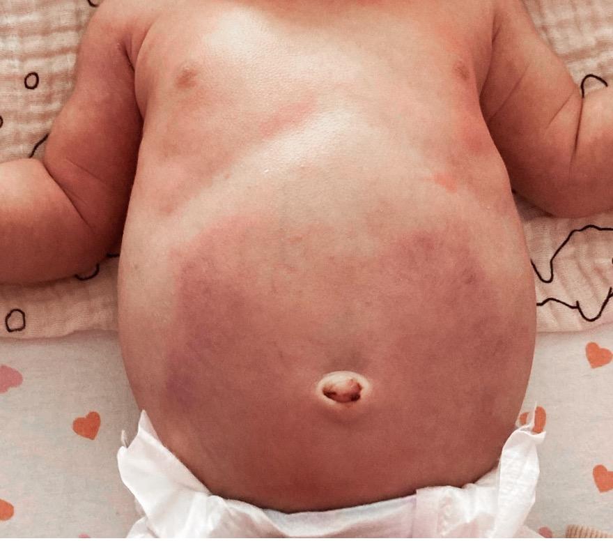 Buik van een liggende neonaat met roodpaarse vlekken rondom de navel.