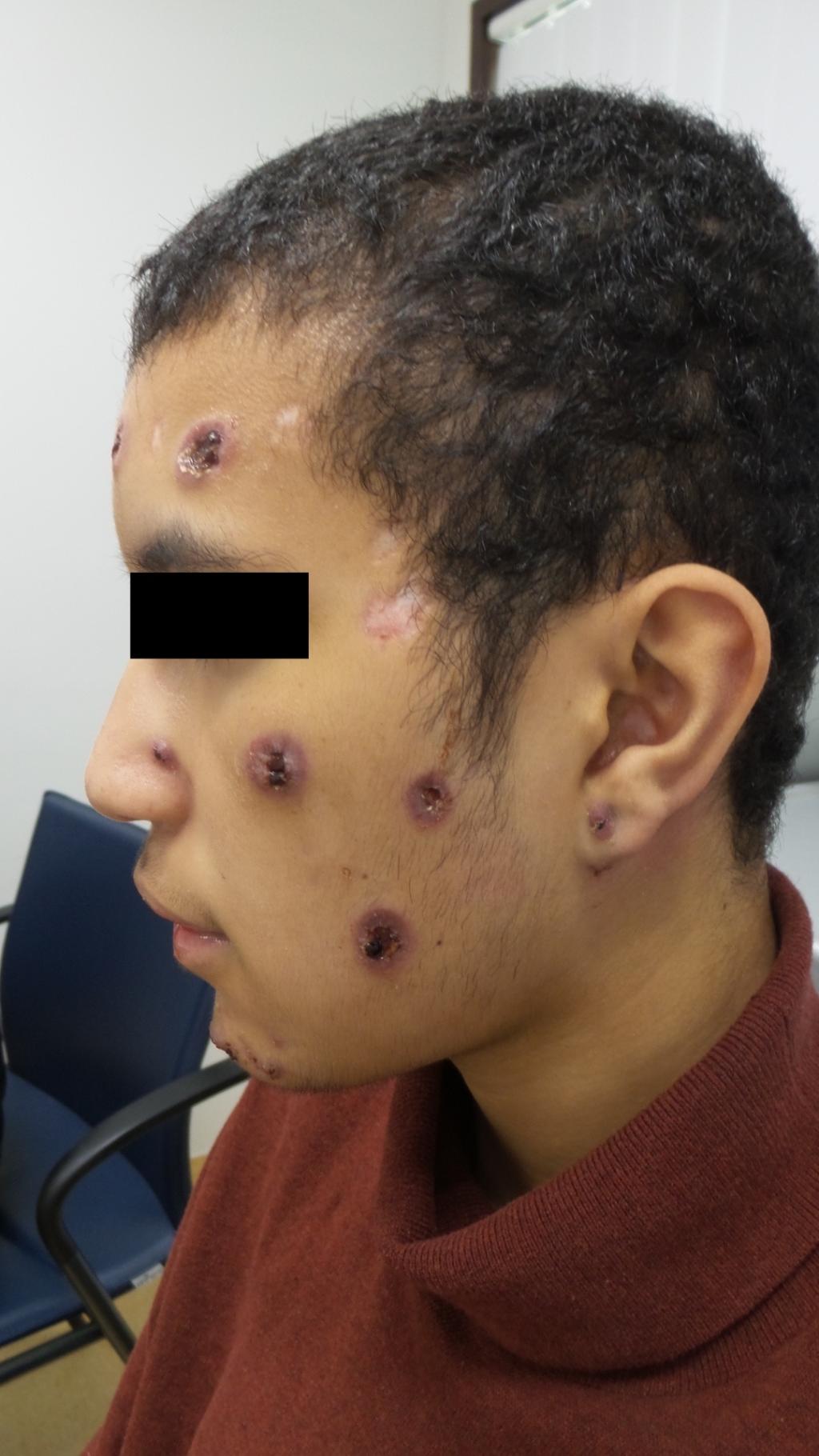 Man met putten in het gelaat.