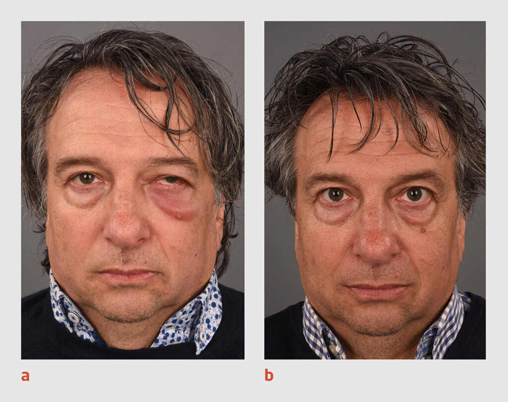 Klinisch beeld vóór en na tandextractie