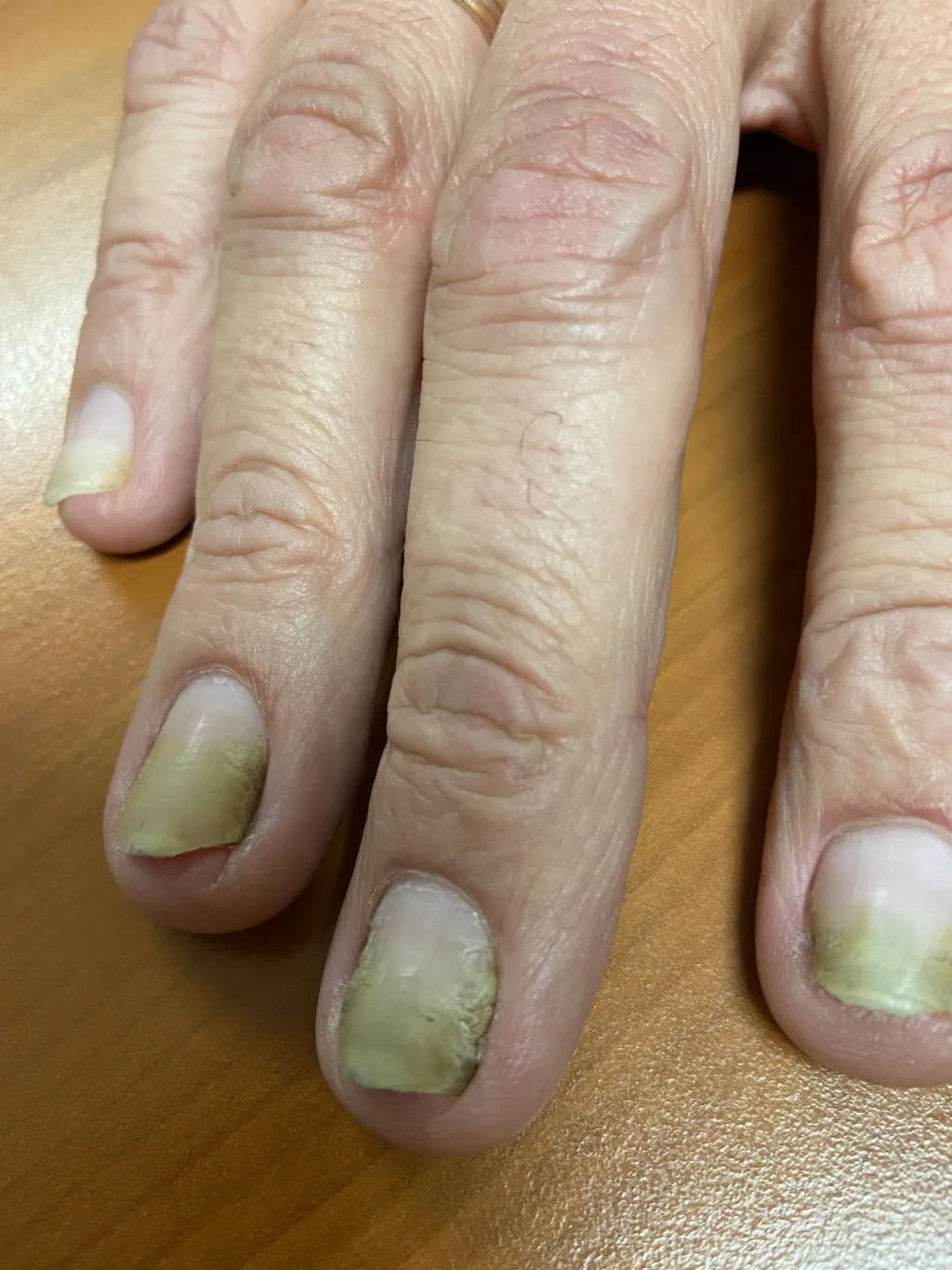 hand met gelige nagels