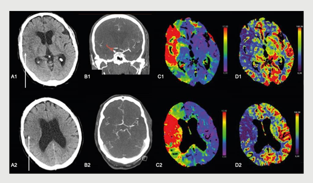 Figuur | Uitgebreide tekenen van infarcering op de CT van een 61-jarige man met een acuut herseninfarct