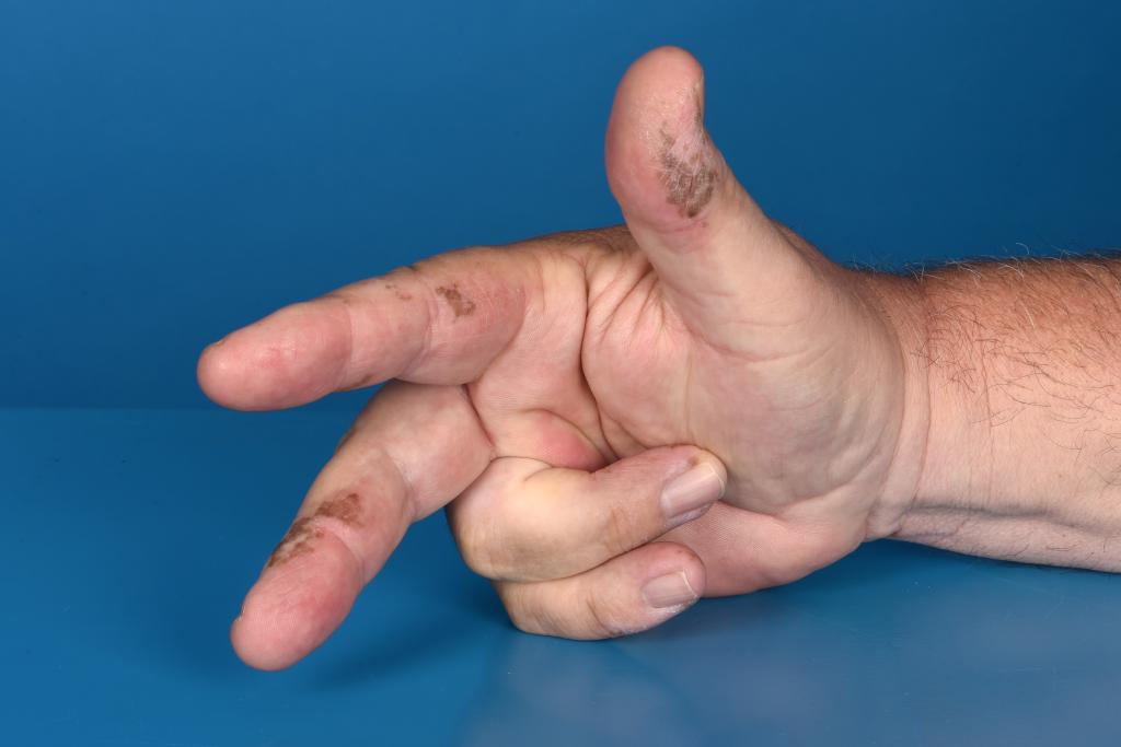 Een rechterhand die duim-, wijs- en middelvinger uitsteekt waar bruine vlekken op te zien zijn.