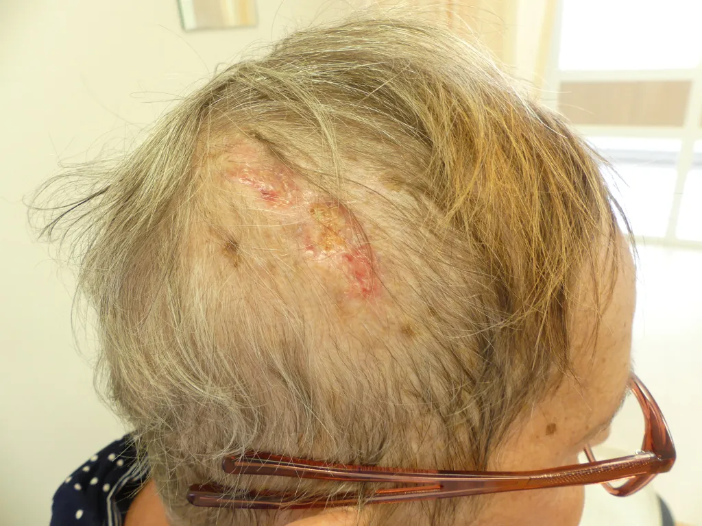 Vrouw met ulcera op haar hoofd